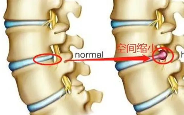 腰间盘突出怎样锻练？五个方法有助于预防再发作